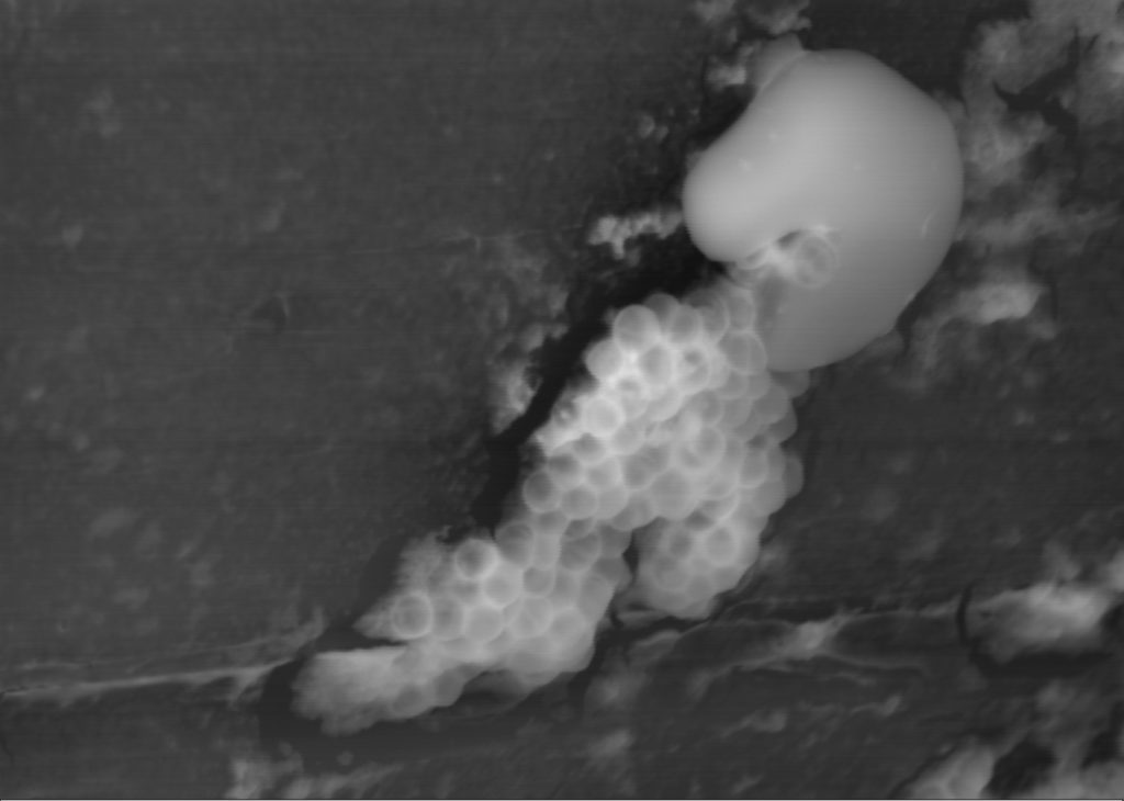 Staphylococcus aureus colony on an explanted drainage 